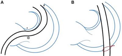 Pulmonary Regurgitation- Is the Future Percutaneous or Surgical?